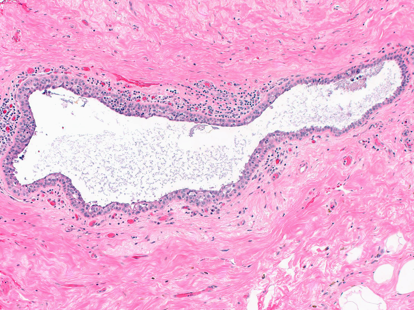 1-18_NA_periductal_stroma_6.30.14.jpeg