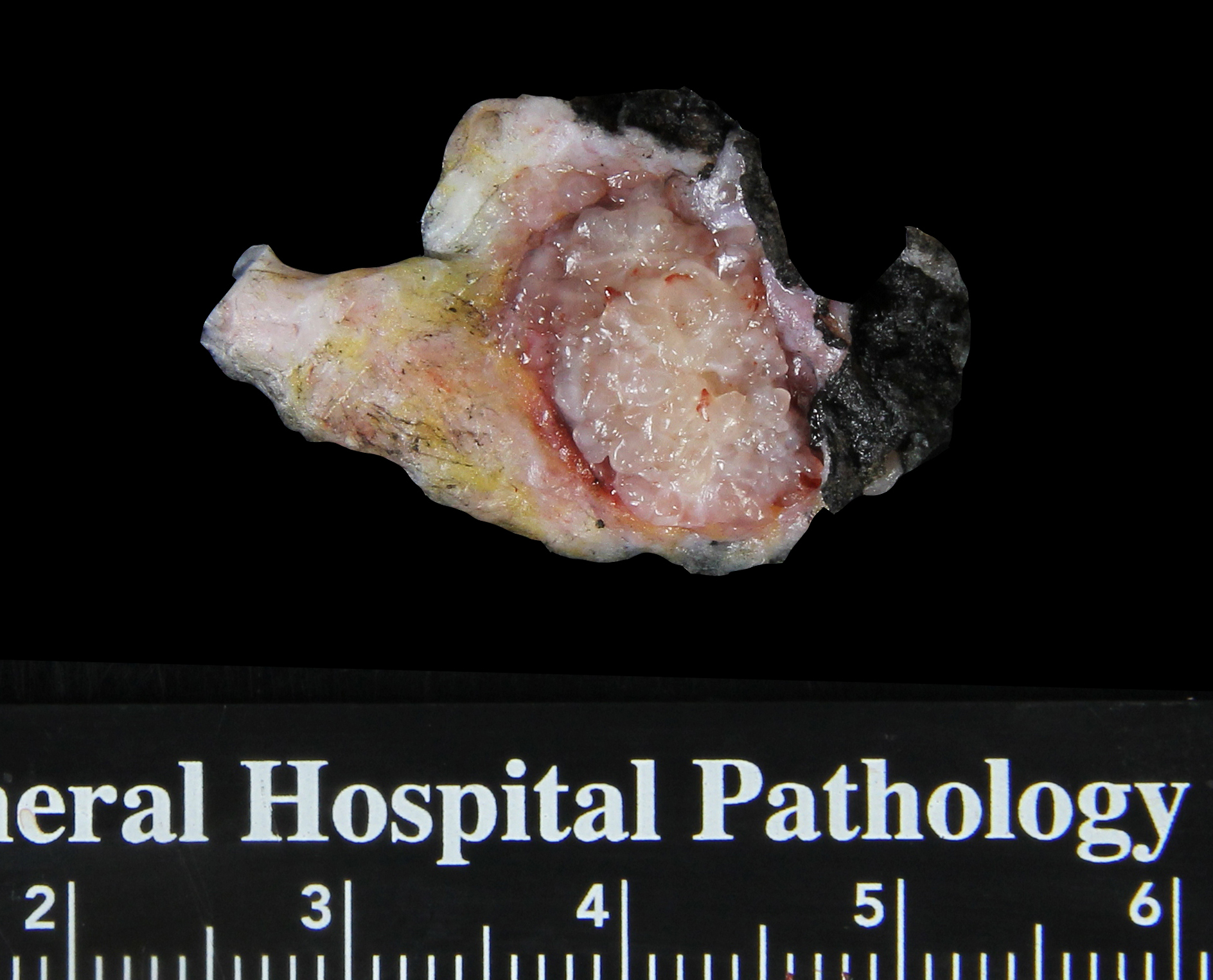 2-16_Myxoid_nodule.jpg