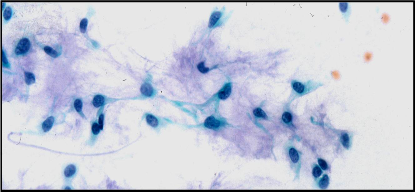 1-9-3_pleomorphic%2Badenoma%2Bw%2Bfibrillar%2Bmix.jpeg