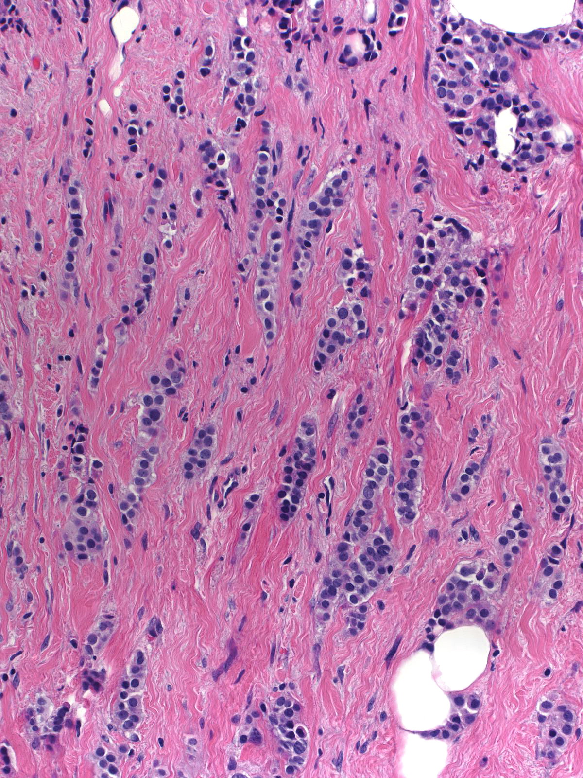 11-30_Invasive_carcinoma_20_x_D.jpg