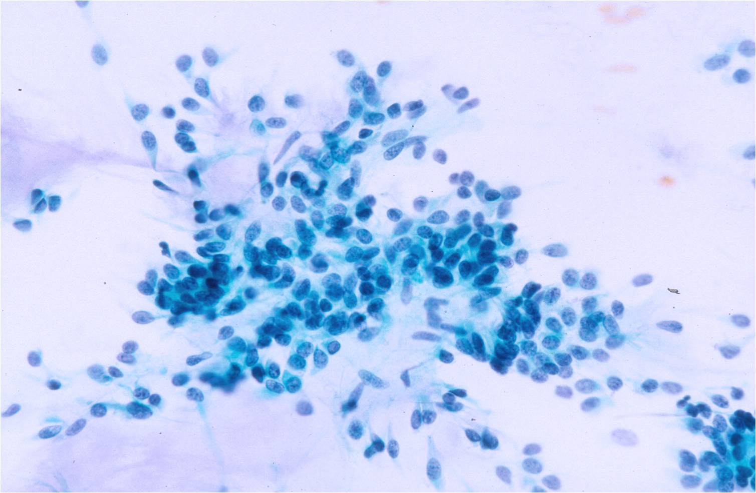 1-9-6_bland%2Bmyoepithelial%2Bcells%2Bpleiomorphic%2Badenoma.jpeg