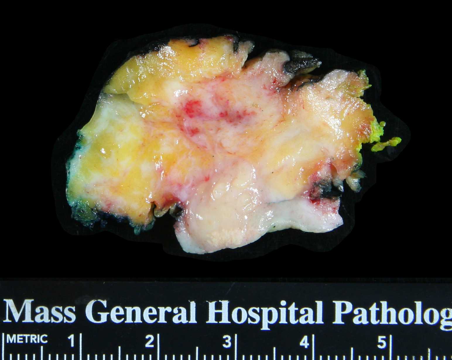 2-24_Hemorrhagic_carcinoma.jpg