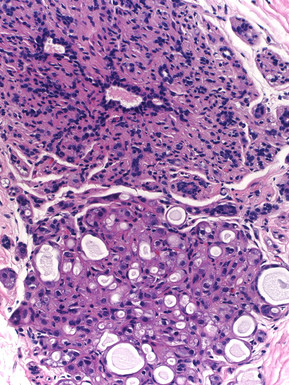 16-10_Atypical_Apocrine_Adenosis_20_x_B.jpg