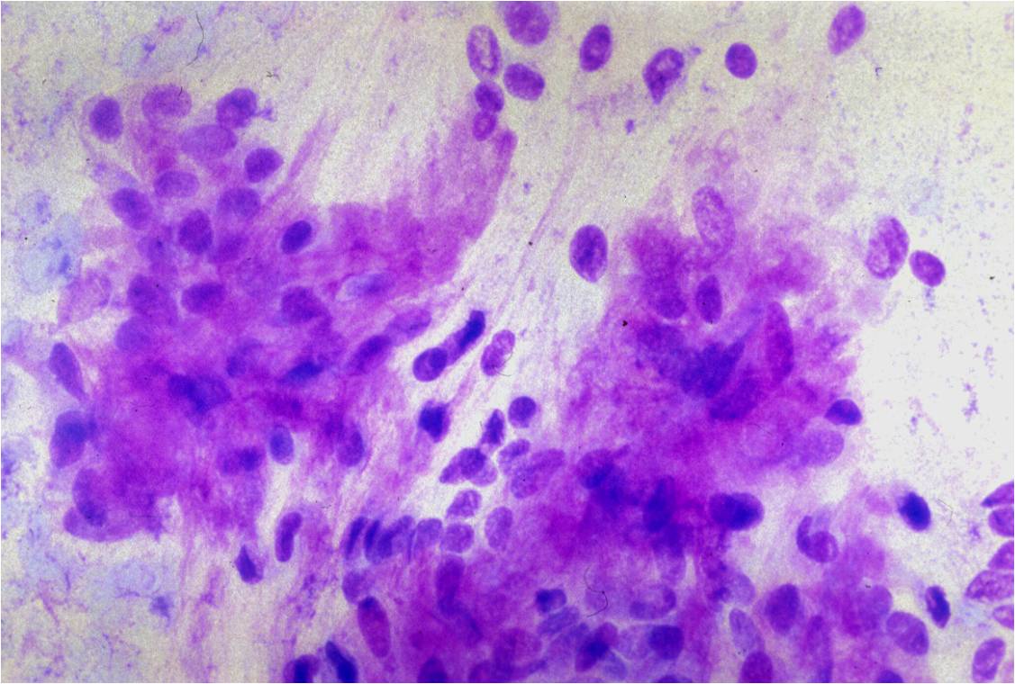 1-9-5_metachromatic%2Bmatrix%2Bpleo%2Badenoma.jpeg