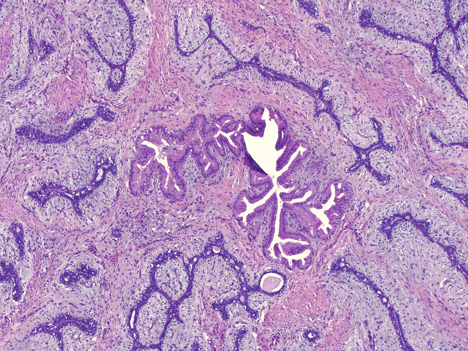 Apocrine_metaplasia.jpg