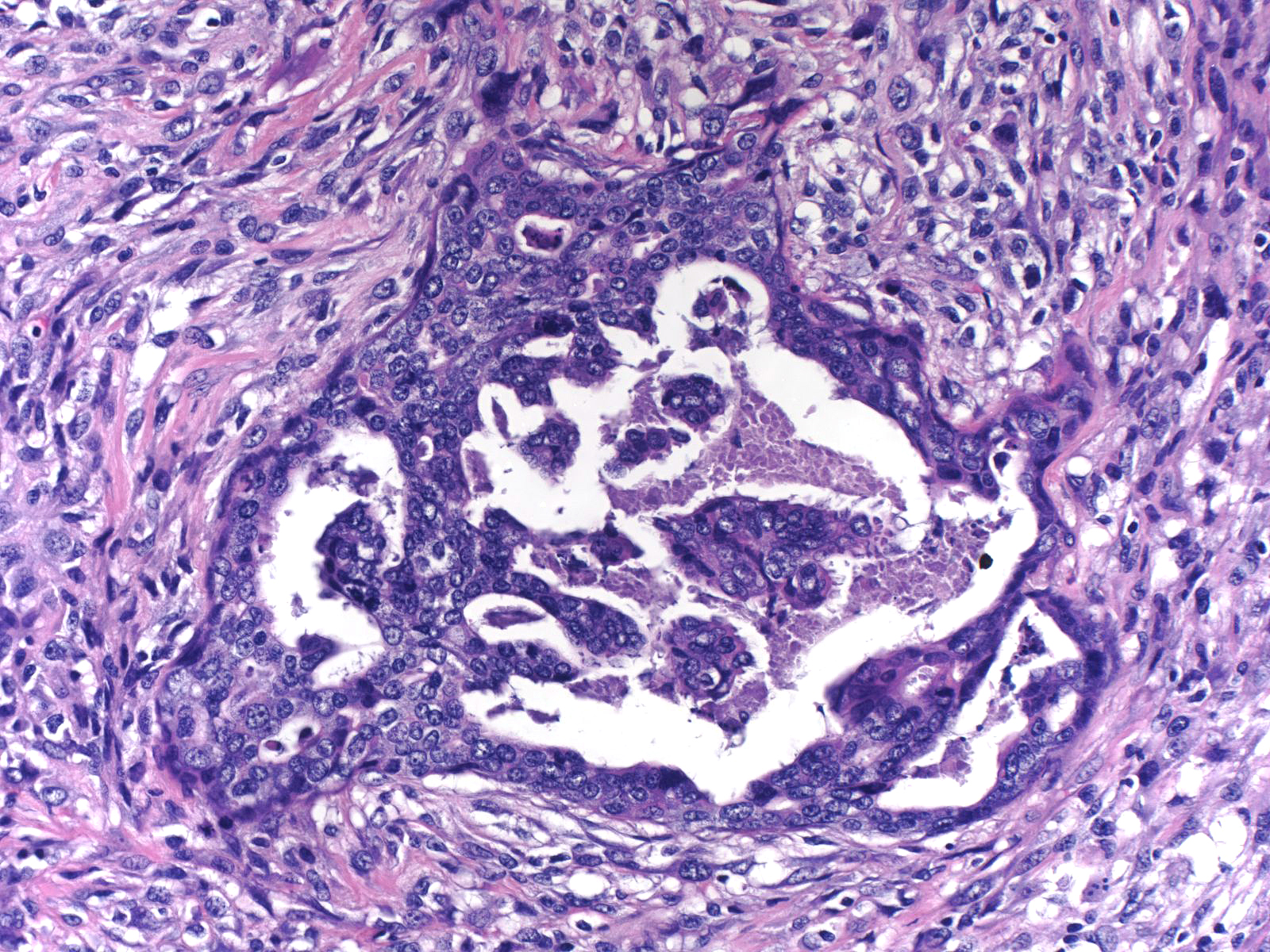 27-11_Spindle_cell_carcinma_w_glands_20_x_B.jpg