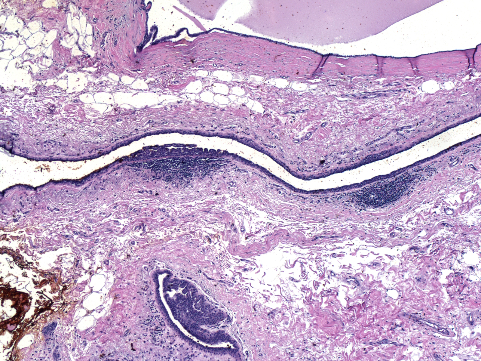 1-22_Lymphoid_aggregate_5_x.jpg