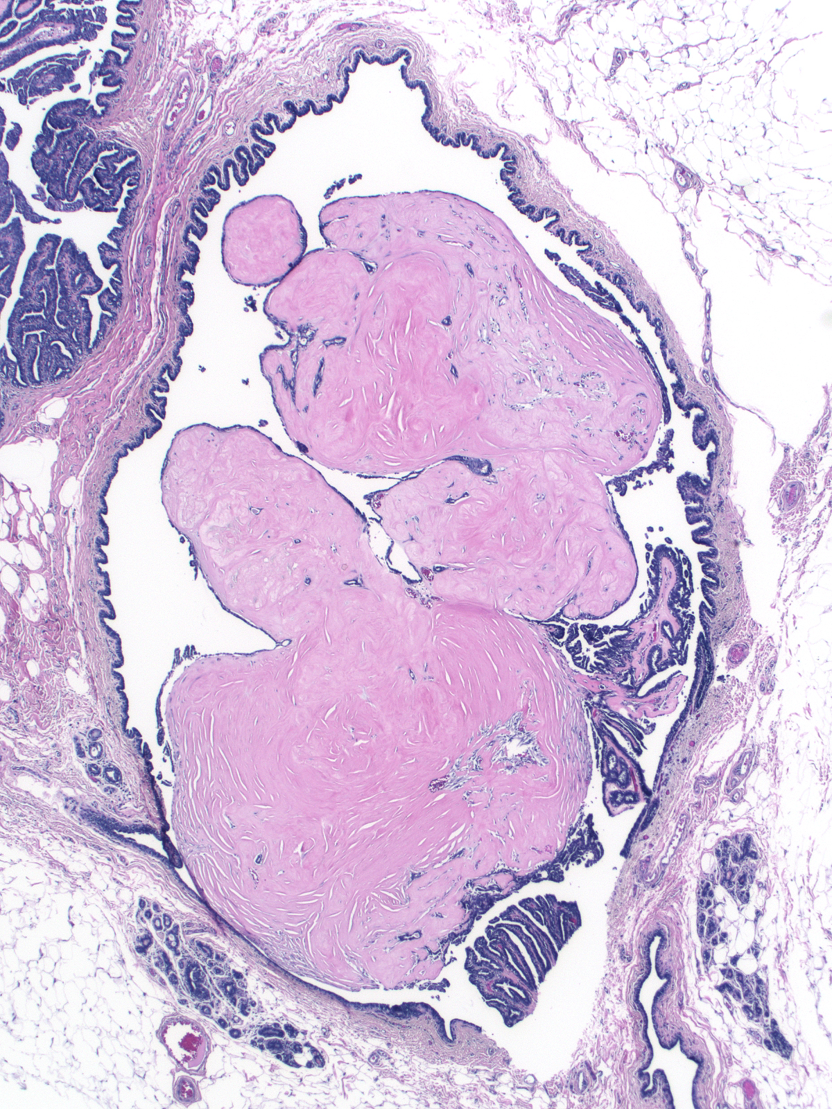 14-15_Pap_w_sclerosis.jpg