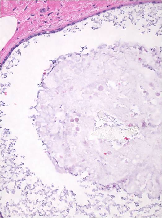 4-6_RC_calcium_oxalate_8.5.14.jpeg.jpg