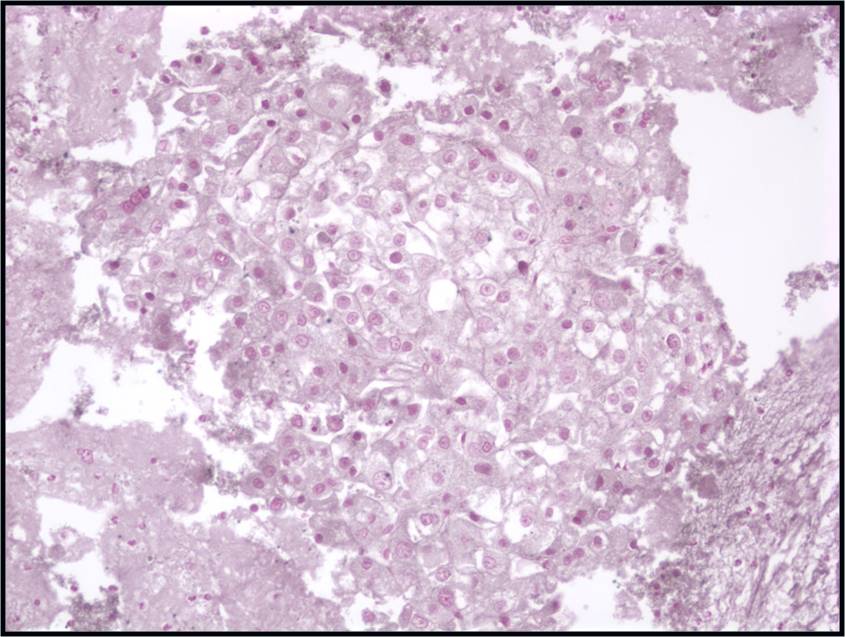 1-10-7_HCC._reticulin_stain_with_loss_of_staining._N13-6335.jpg