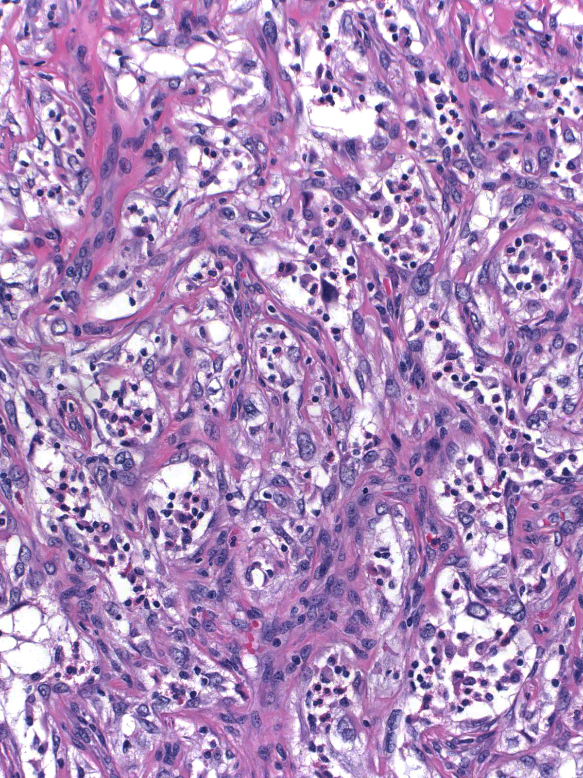 27-9_Spindle_cell_pseudovascular_w_eos_20_x_C.jpg