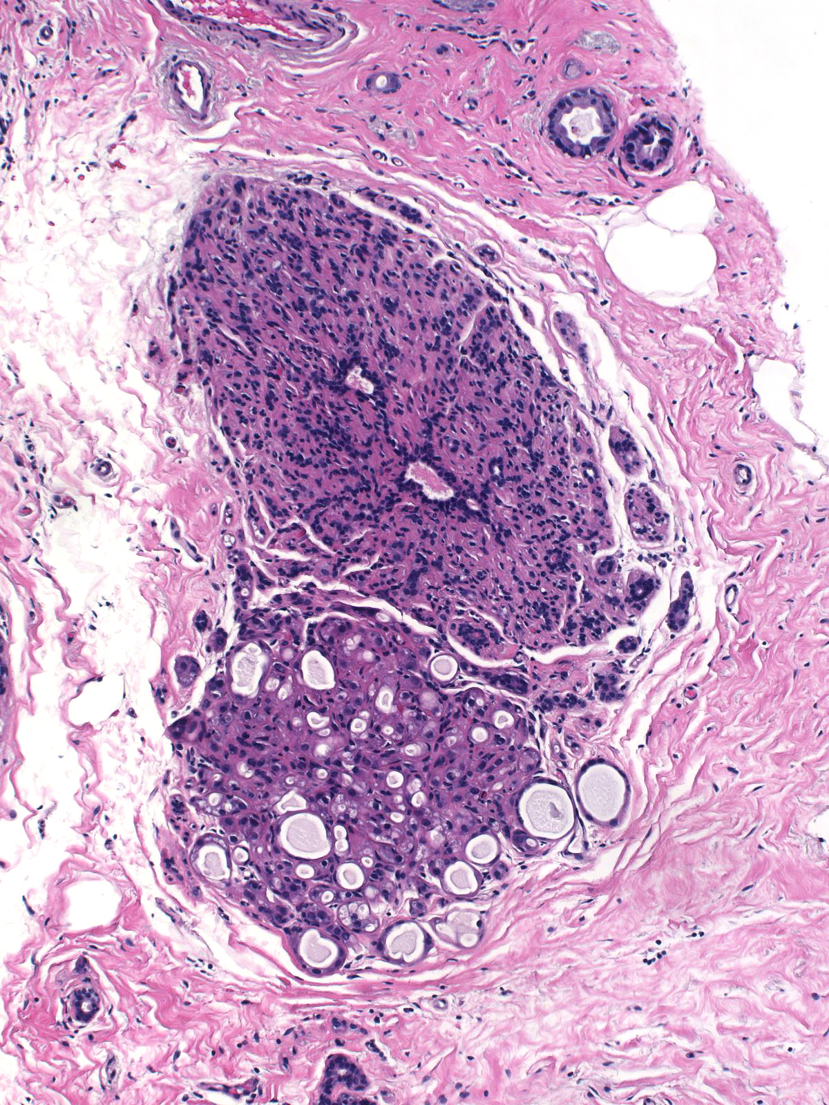 16-9_Atypical_Apocrine_Adenosis_10_x_B.jpg