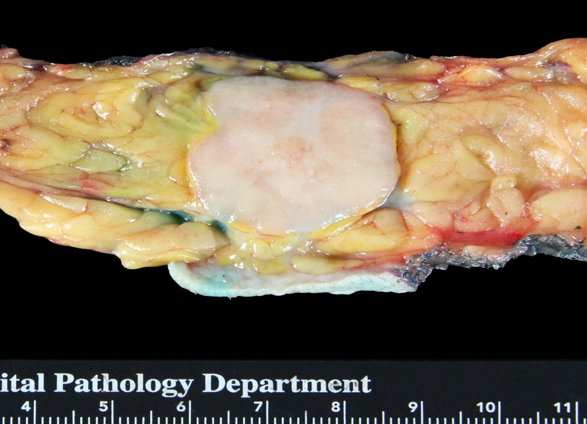 2-22_round_carcinoma_%28sq%29.jpg