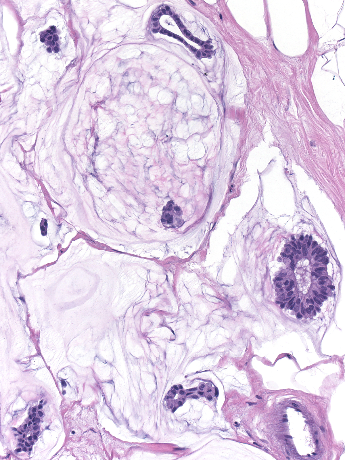 28-15_Mucinous_carcinoma.jpg