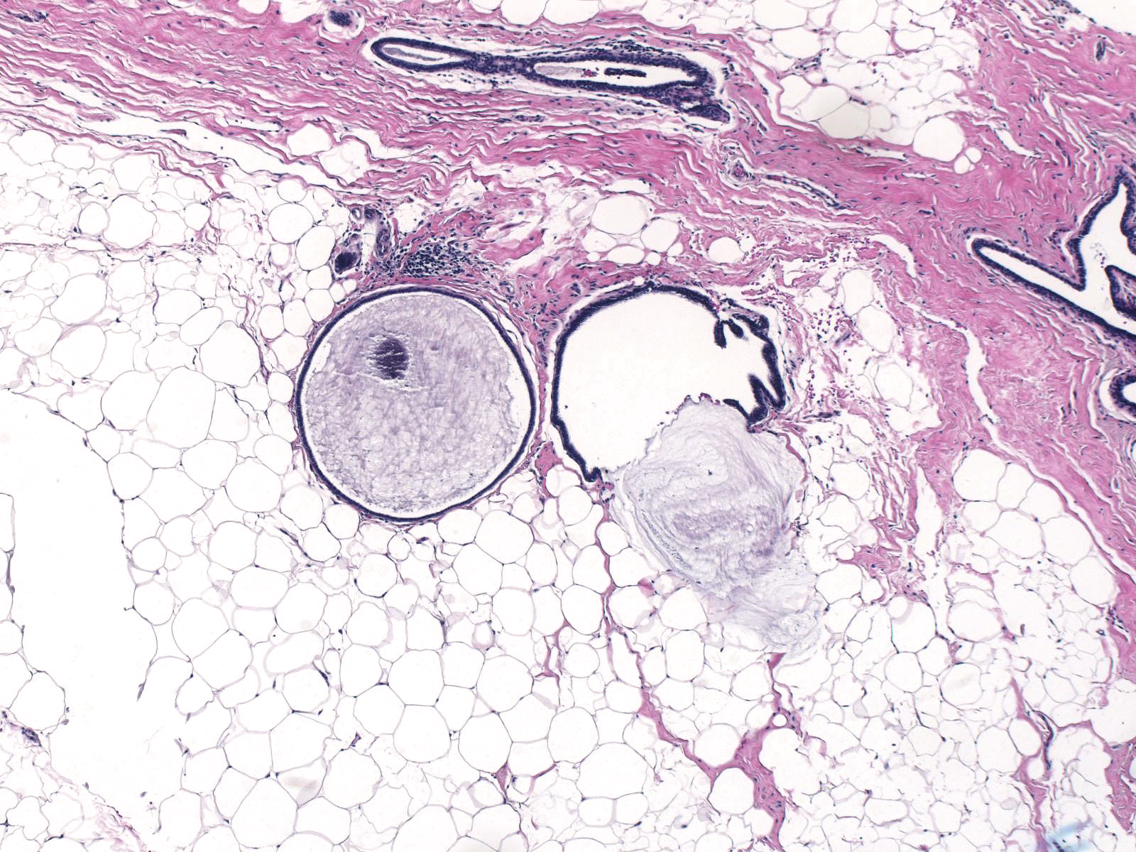 12-9_Iatrogenic_mucin_5_x_B.jpg