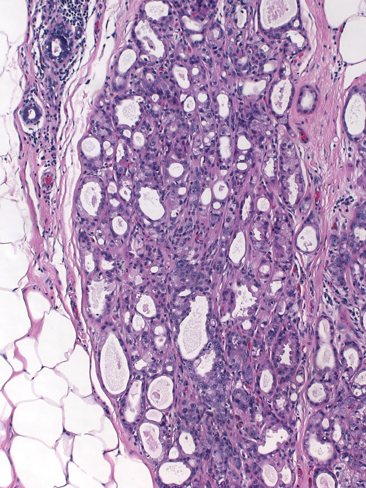 16-11_Atypical_Apo_Adenosis_w_DCIS_10_x_F.jpg