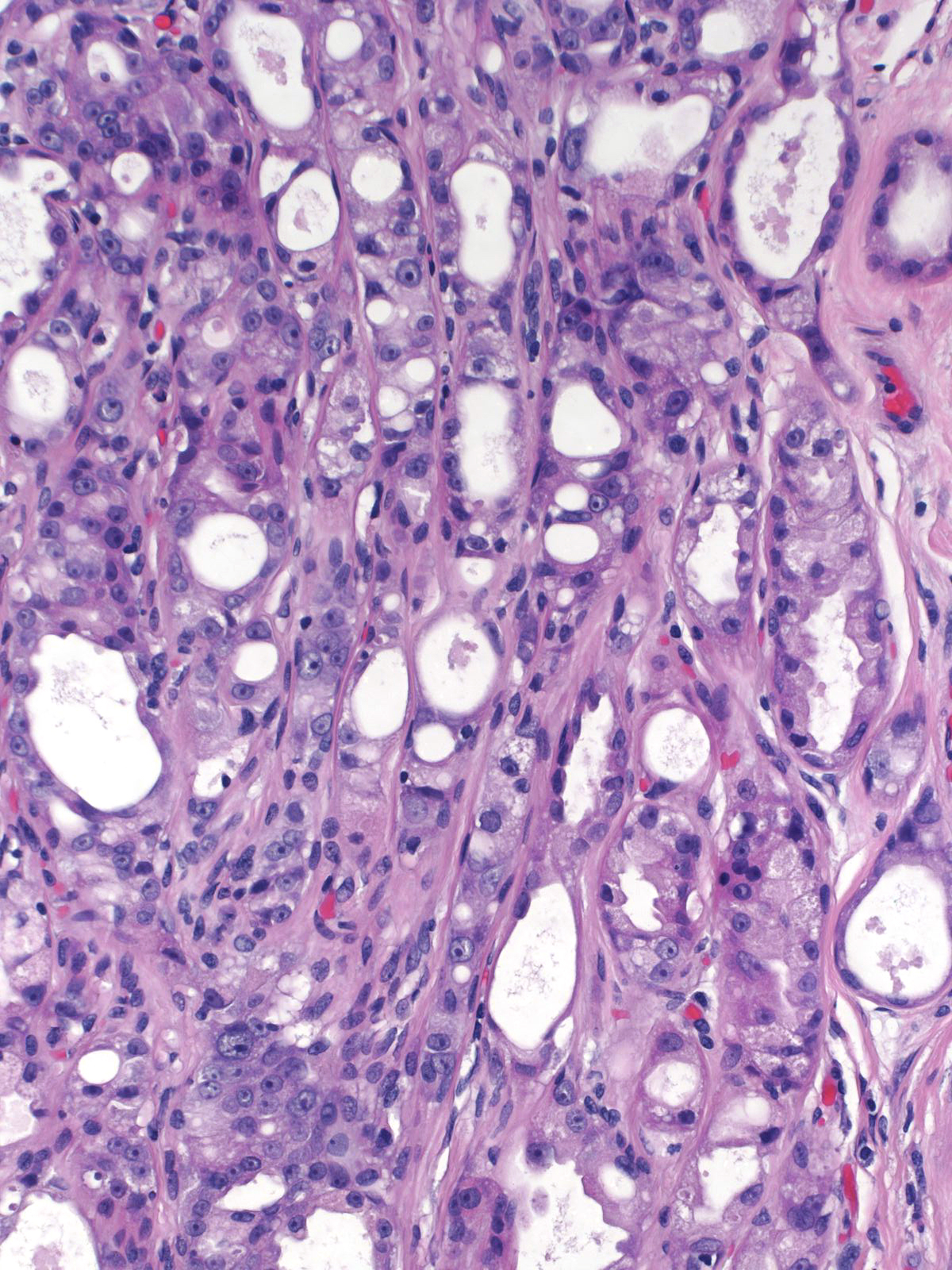 16-12_Atypical_Apo_Adenosis_w_DCIS_20_x_E.jpg