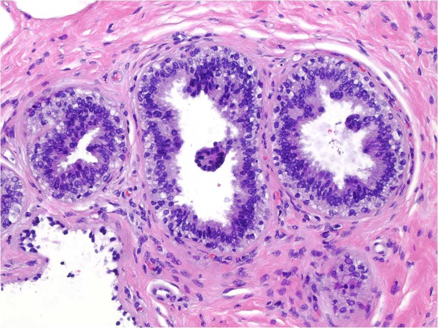 Blunt Duct Adenosis (BDA) - MGH Learn Pathology