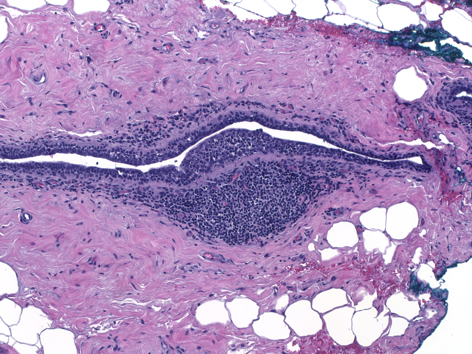 1-23_Lymphoid_aggregate_10_x.jpg