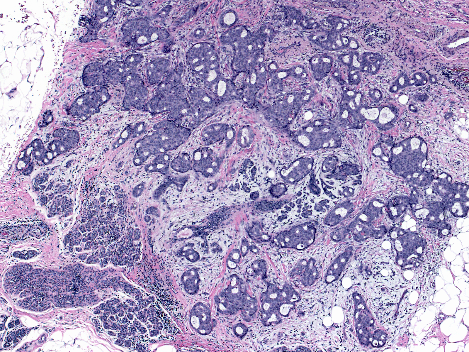 10-14_Ductal_carcinoma_in-situ_like.jpg