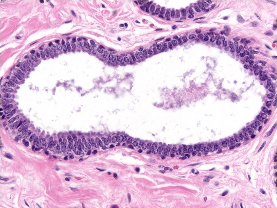 Blunt Duct Adenosis (BDA) - MGH Learn Pathology