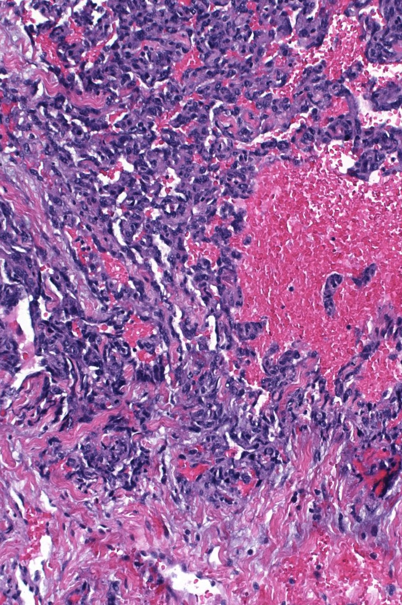 Angiosarcoma - Mgh Learn Pathology