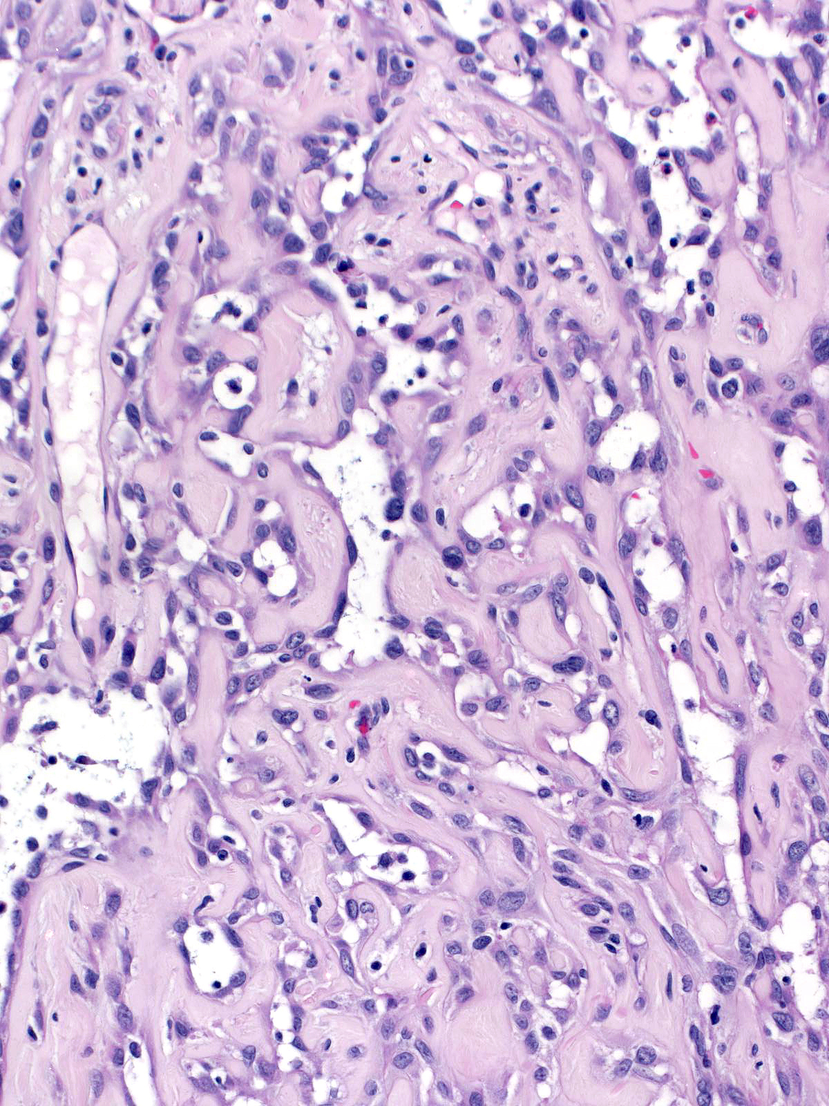 27-8_Spindle_cell_Pseudovascular_w_bv_20_x_O.jpg