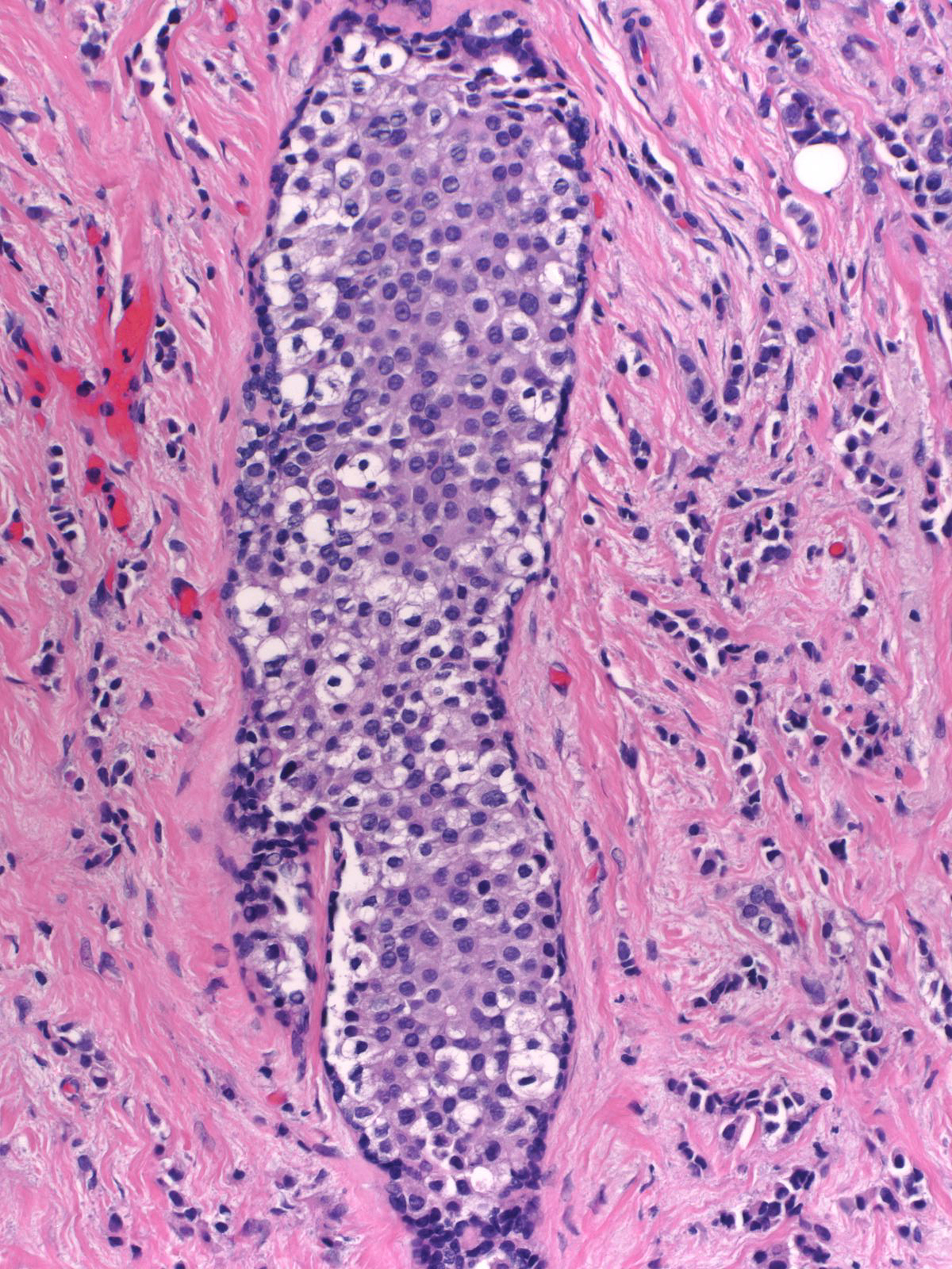 11-31_In-situ_carcinoma_20_x_G.jpg