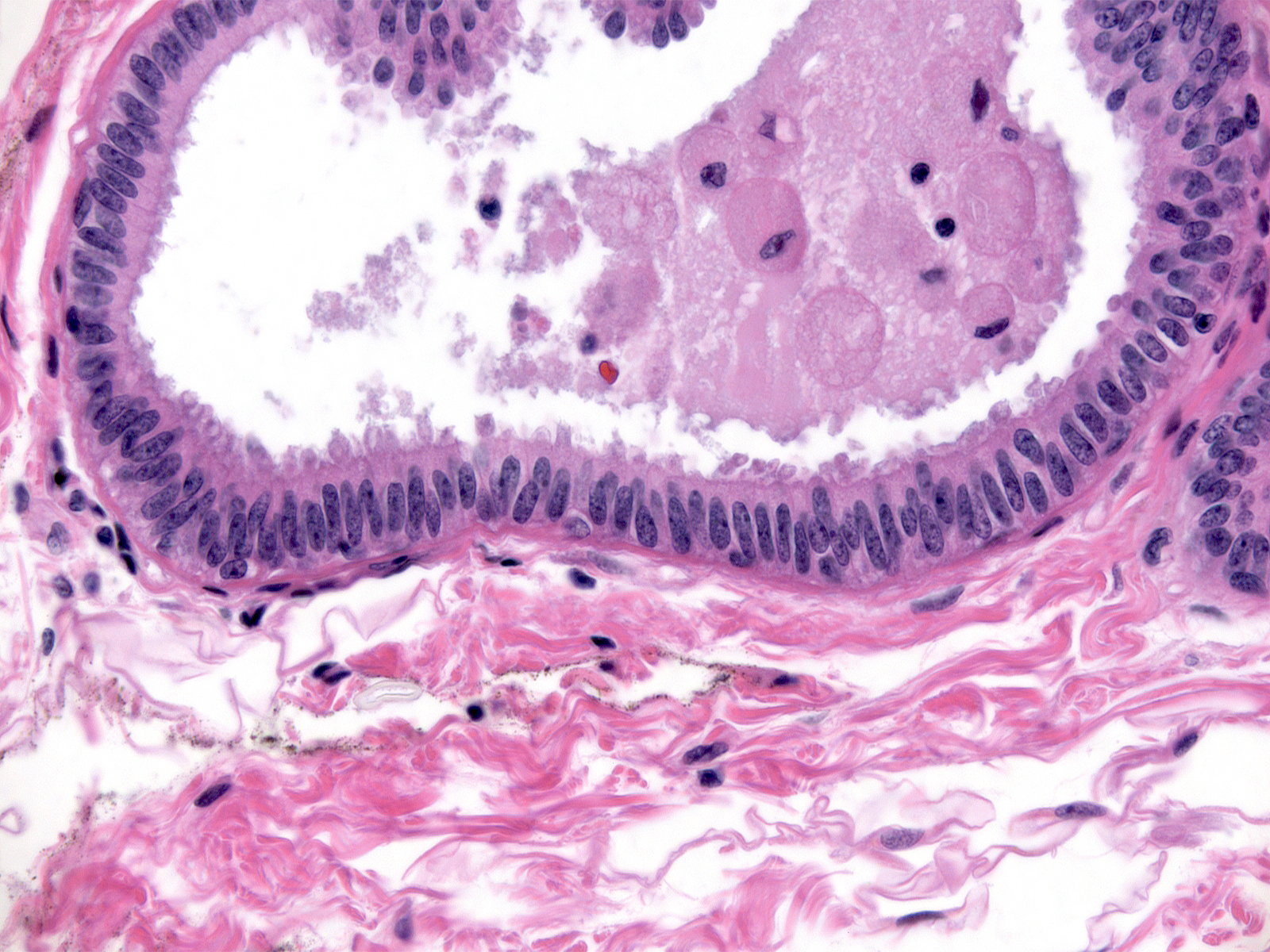 Flat Epithelial Atypia (FEA) - MGH Learn Pathology