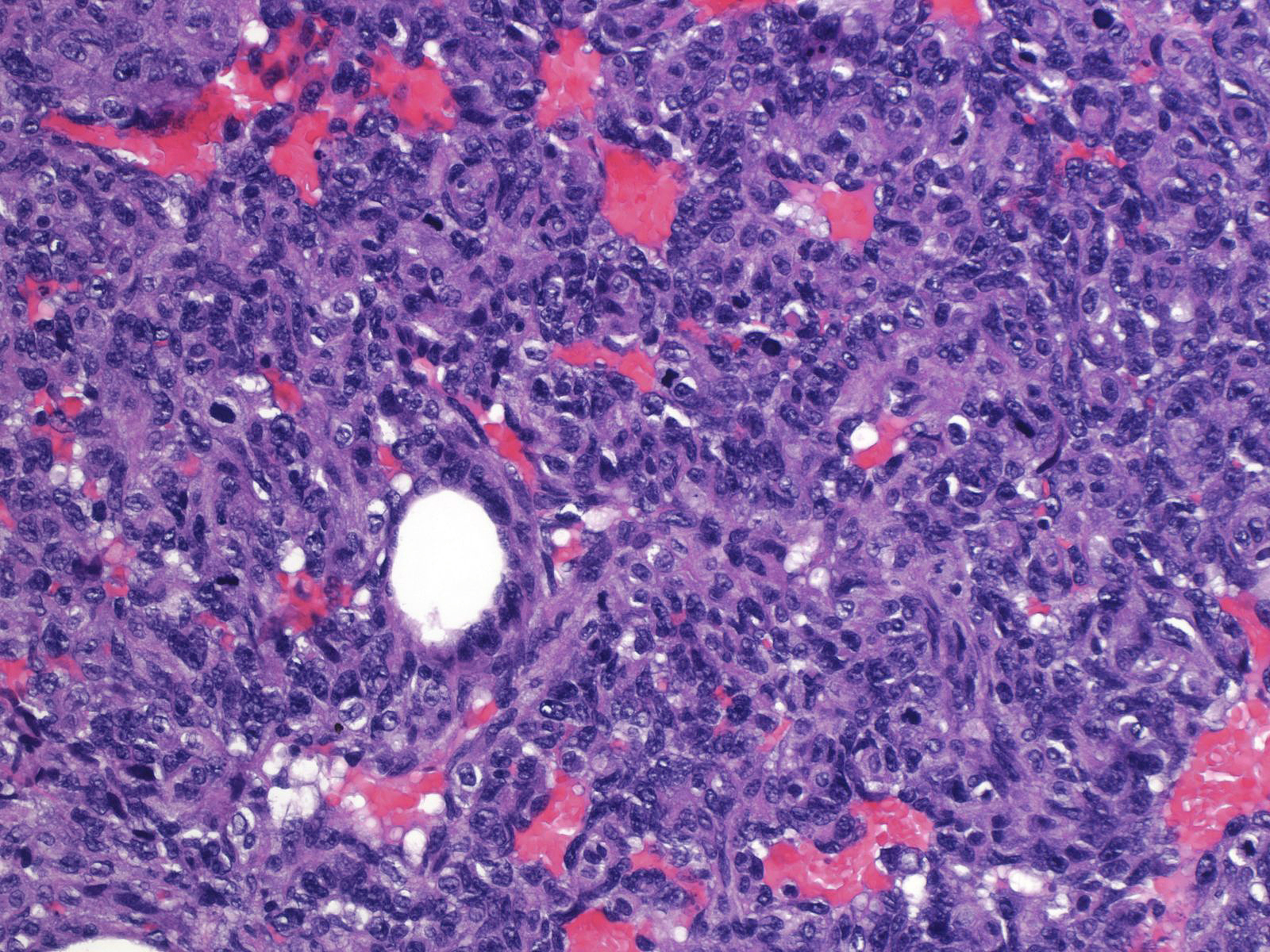 22-8_Solid_with_mitoses.jpg