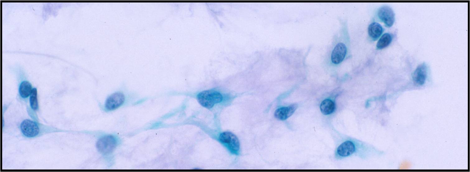 1-9-4_pleomorphic%2Badenoma%2Bw%2Bstellate%2Bmyoepithelial%2Bcells.jpeg