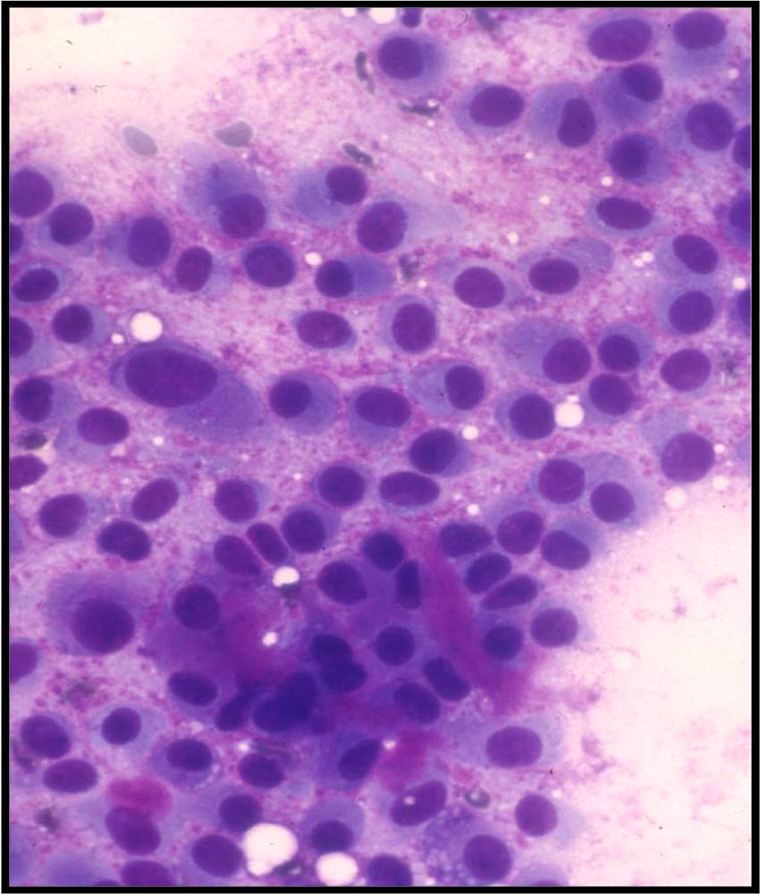 1-9-7_plasmacytoid%2Bmyoepithelial%2Bcells%2Bpleo%2Badenoma.jpeg