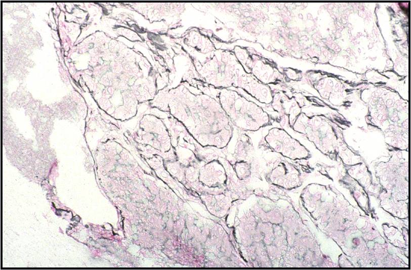 1-10-6_HCC._reticulin_staining_with_staining_of_thickened_trabeculae.N13-6335..jpg