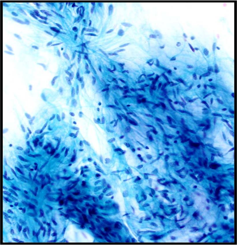 1-9-8_spindled%2Bmyoepithelial%2Bcells%2Bpleo%2Badenoma.jpeg