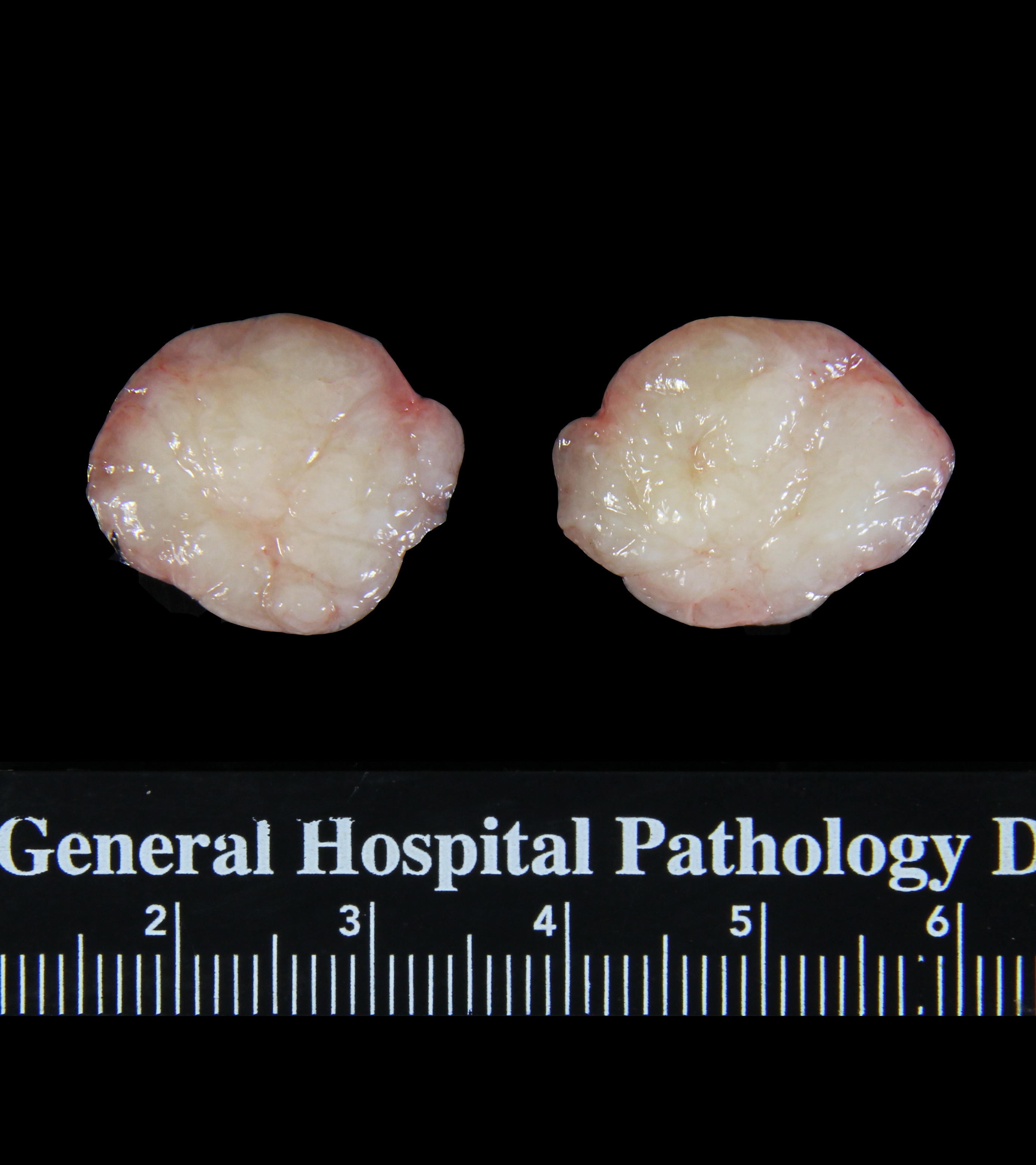 Fibroadenoma_gross_closeup.jpg