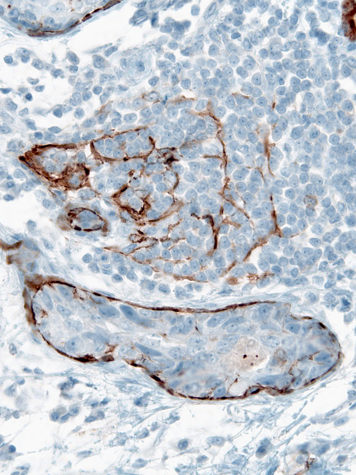 7-22_Myosin_Lymphoid_40_x.jpg